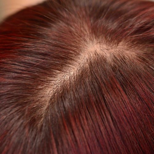 Trattamento Cute Padova